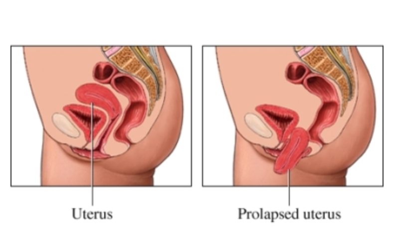 Prolapse cervix