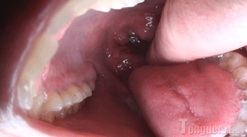 Cutlass reccomend tongue uvula